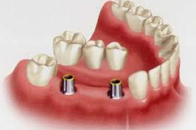 Replacing Multiple Teeth | Orange County Dental Implant Center