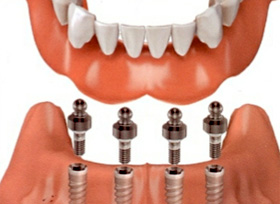 About Dental Implants | Orange County Dental Implant Center