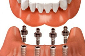 Replacing All Your Teeth | Orange County Dental Implant Center