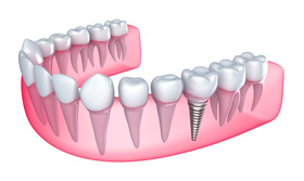 Single-Tooth Replacement | Orange County Dental Implant Center