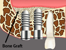 bone-graft1